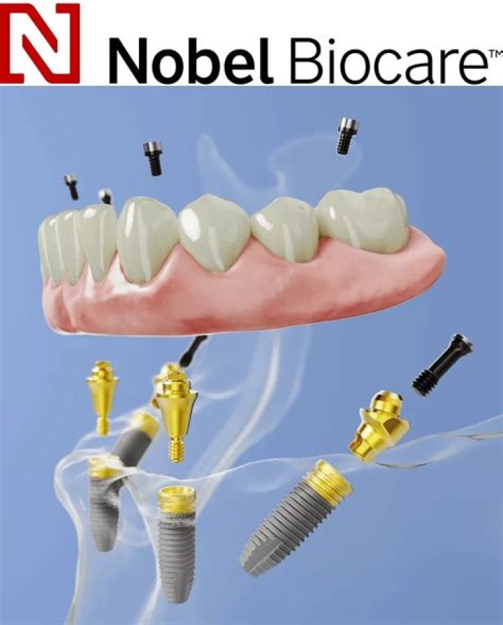 Are Nobel Biocare implants good?