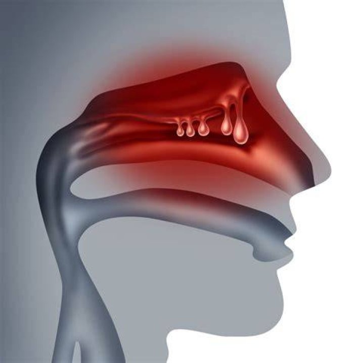 Can anxiety cause swollen nasal passages?