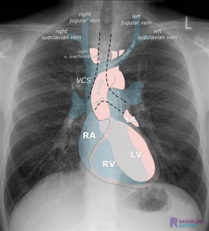 Can chest X rays show heart problems?