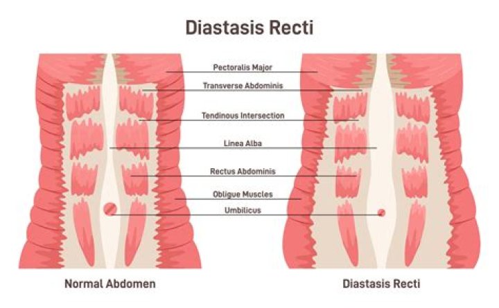 Can diastasis recti heal on its own?