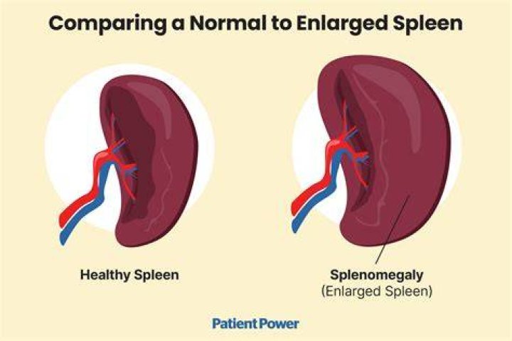 Can exercise hurt your spleen?