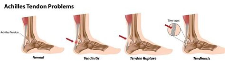 Can I run with a strained Achilles?