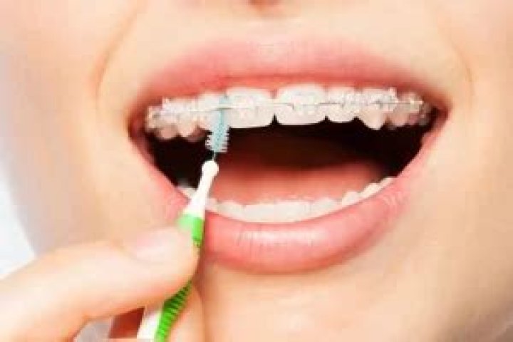 Can interdental brushes damage gums?