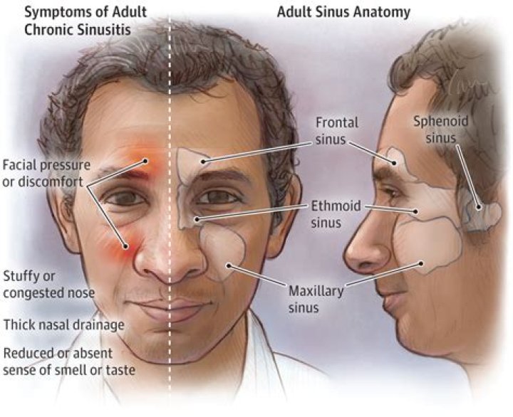 Can sinusitis cause forehead swelling?