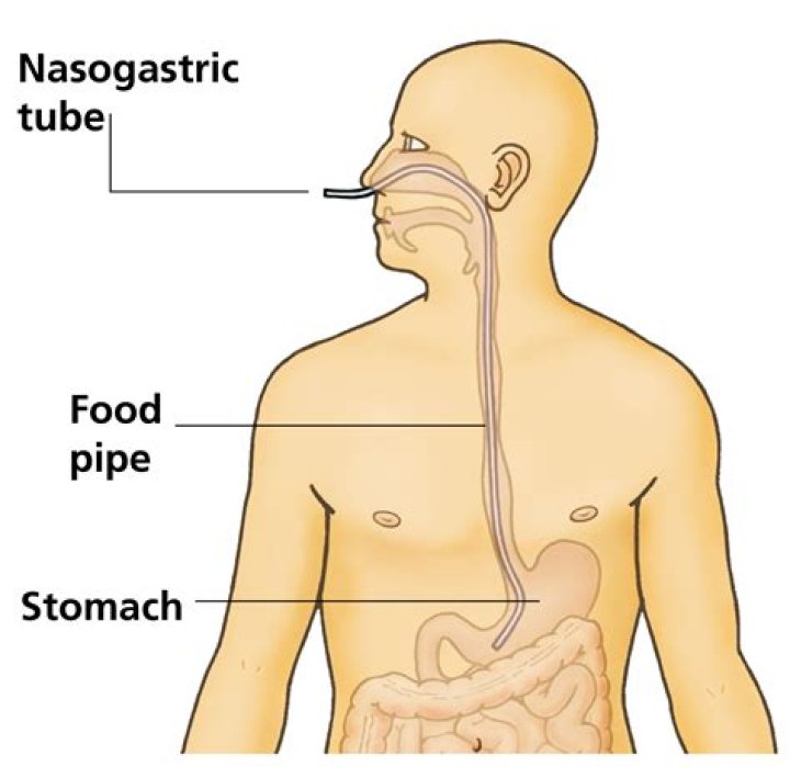 Can you give medications through a nasogastric tube?