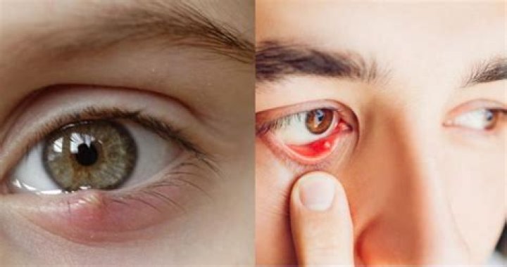 Can you pop a stye when it comes to a head?