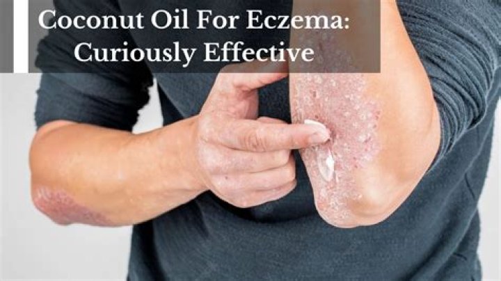 Can you put coconut oil on eczema?
