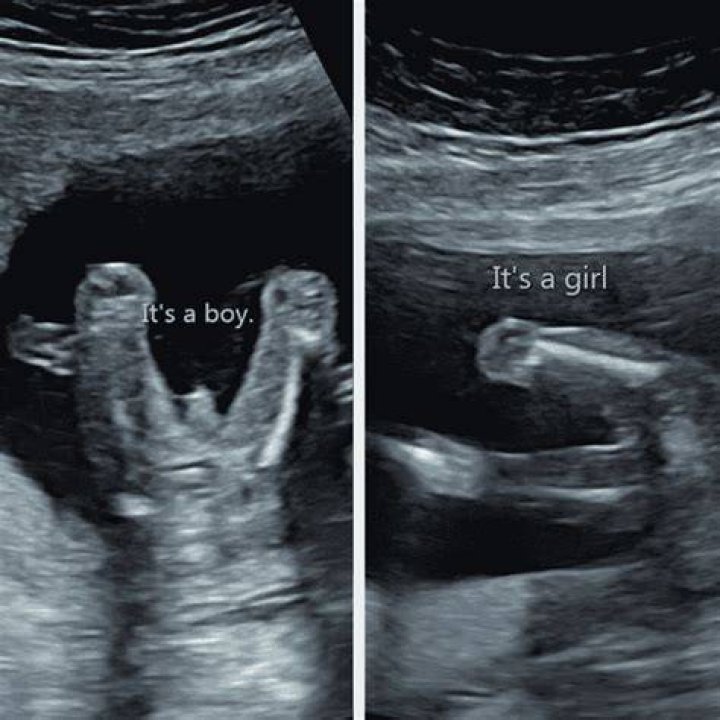 Can you tell the gender at 14 weeks with 3D ultrasound?