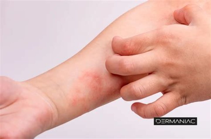 Como curar la dermatitis Atopica de forma natural?