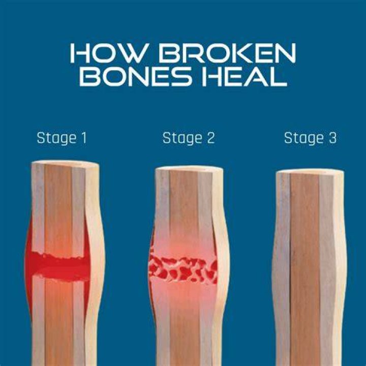 Do sprains heal faster than breaks?
