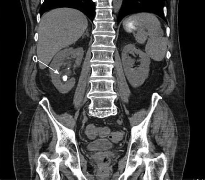 Does a pelvic CT scan show kidney stones?