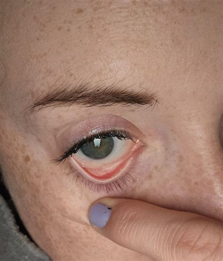 Does anemia cause pale eyelids?