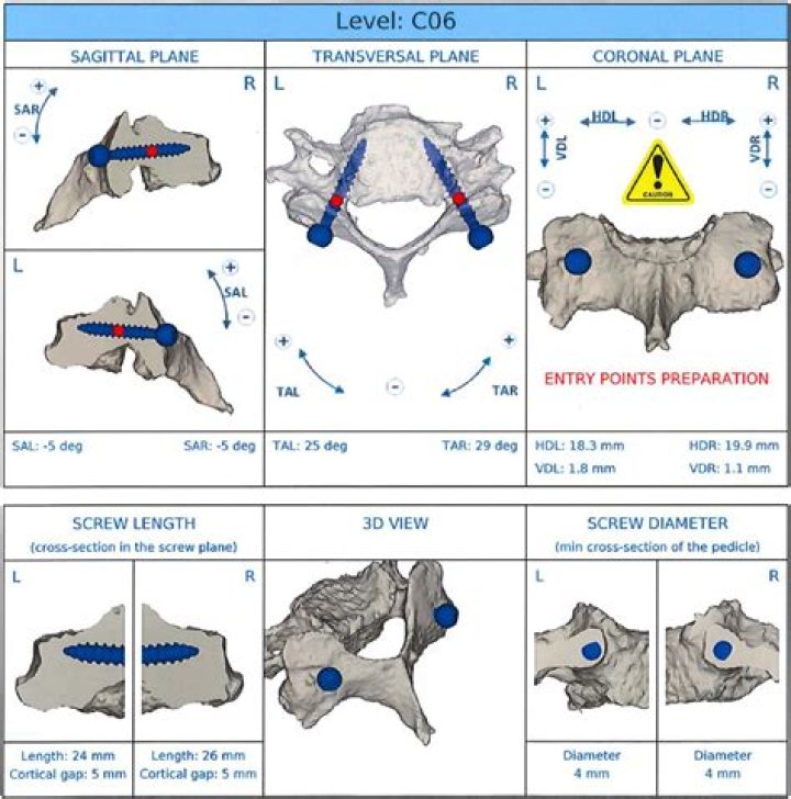 Does C1 have a pedicle?