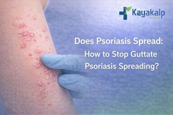 Does guttate psoriasis peel?