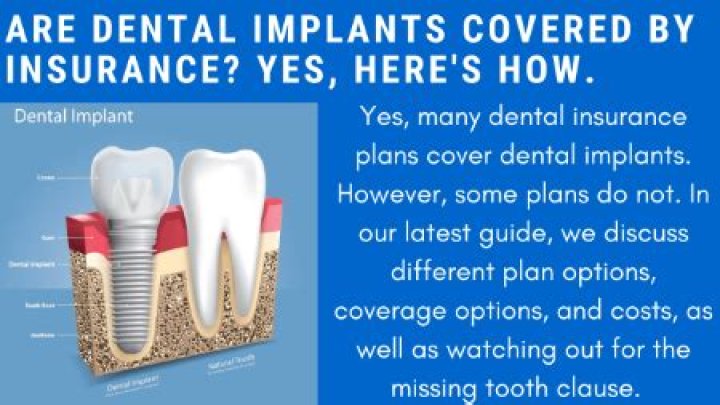 Does MetLife dental insurance cover implants?