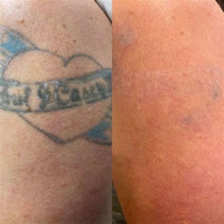 Does Salabrasion actually work?