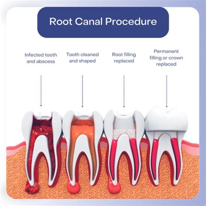 Does UFT cover root canals?