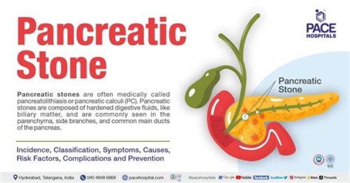 How do they remove stones from the pancreas?