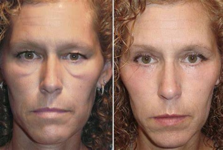 How do you get rid of festoons on cheekbones?