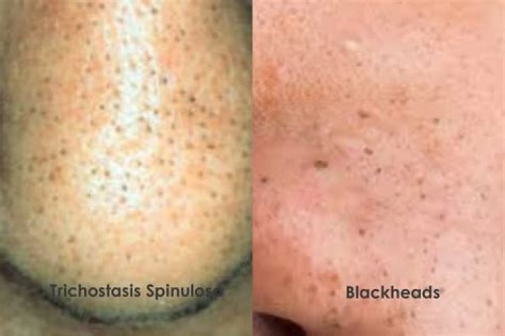 How do you get rid of Trichostasis spinulosa?