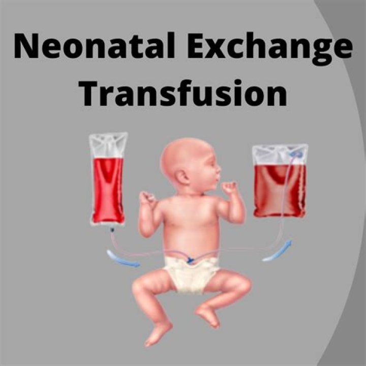 How do you give a newborn an exchange transfusion?