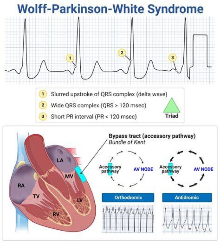 How do you know if you have Wolf Parkinson White Syndrome on ECG?
