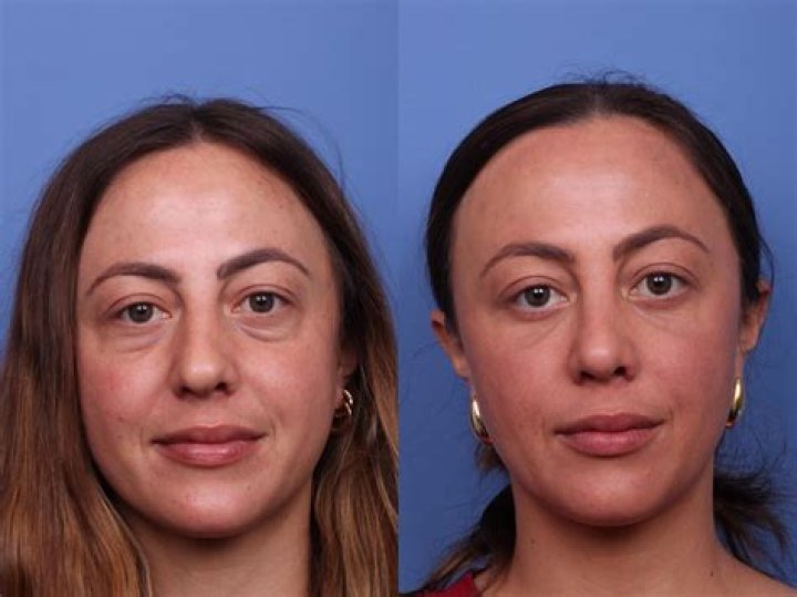 How do you qualify for keyhole surgery?