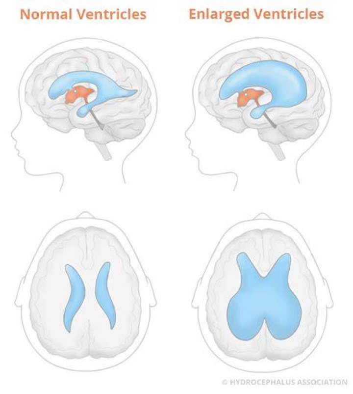 How is obstructive and non obstructive hydrocephalus different?