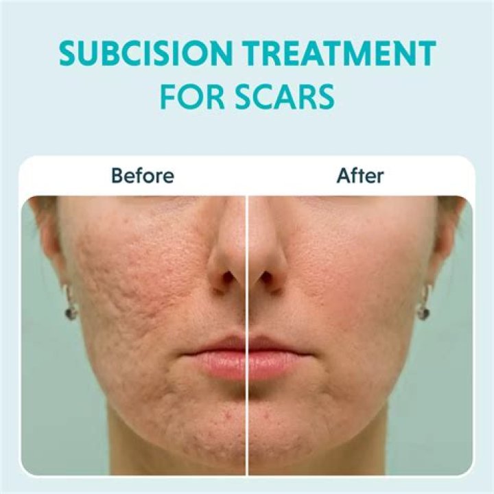 How long does it take for scars to fade after breast surgery?
