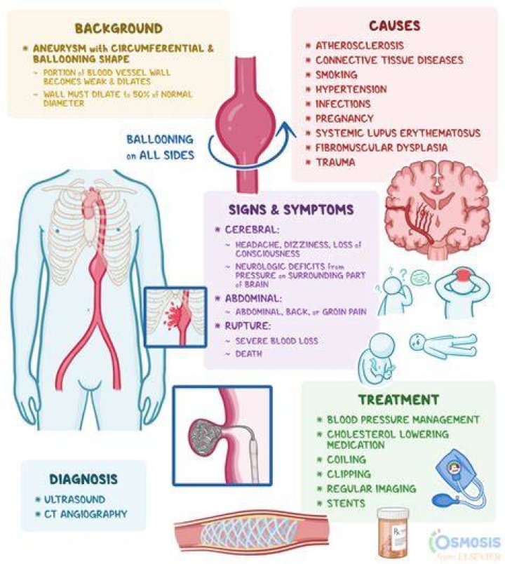 Is a fusiform aneurysm serious?