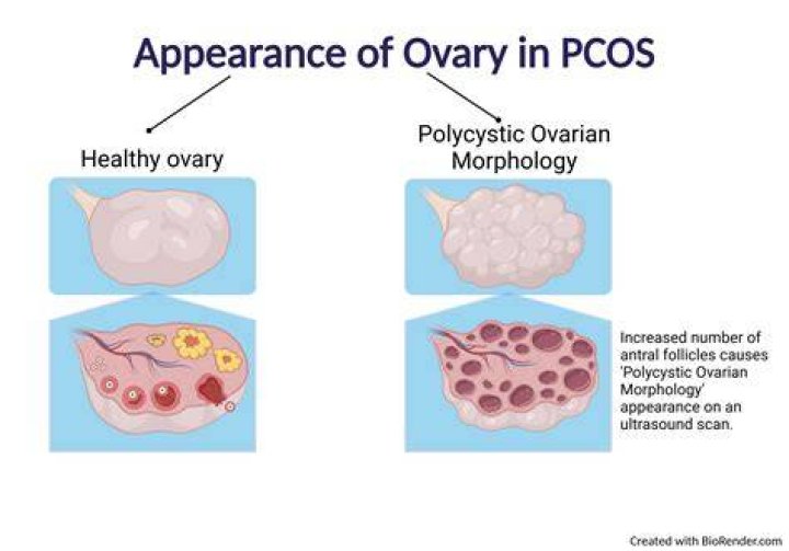 Is Chana bad for PCOS?