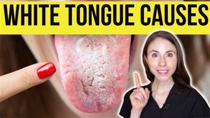 Is it normal to have white stuff on your tongue?