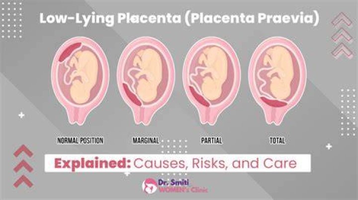 Is low-lying placenta something to worry about?