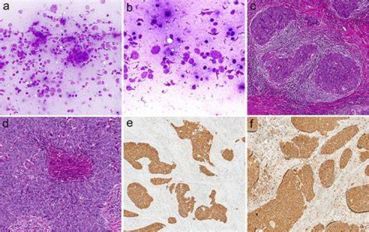 Is Lymphoepithelioma malignant?