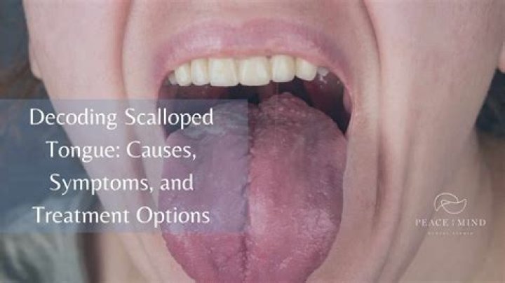 Is scalloped tongue caused by anxiety?