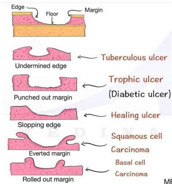 What condition is associated with a saucer shaped ragged ulcer?