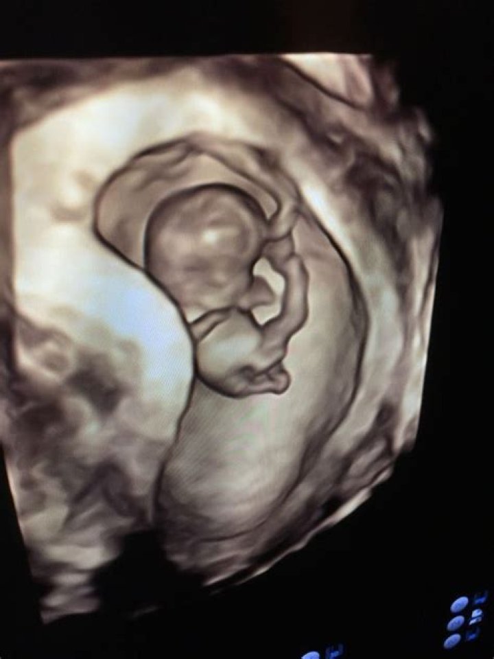 What does a scan look like at 9 weeks?