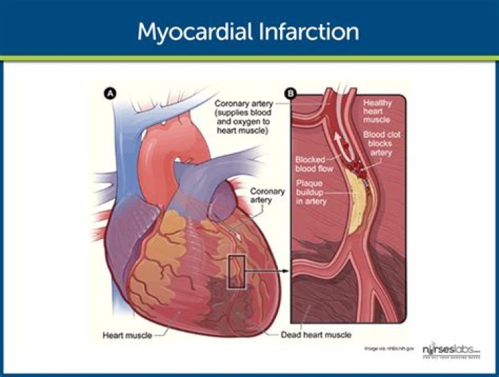 What does anterior wall ischemia mean?