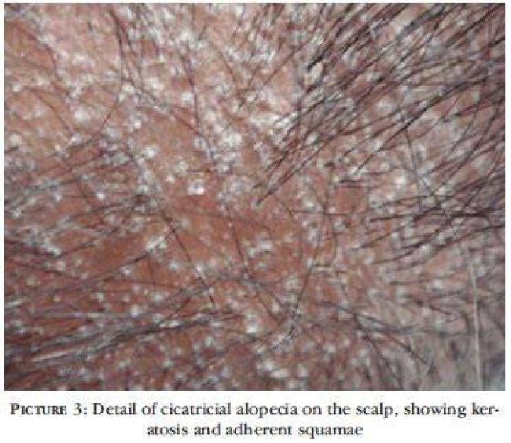 What does follicular hyperkeratosis look like?