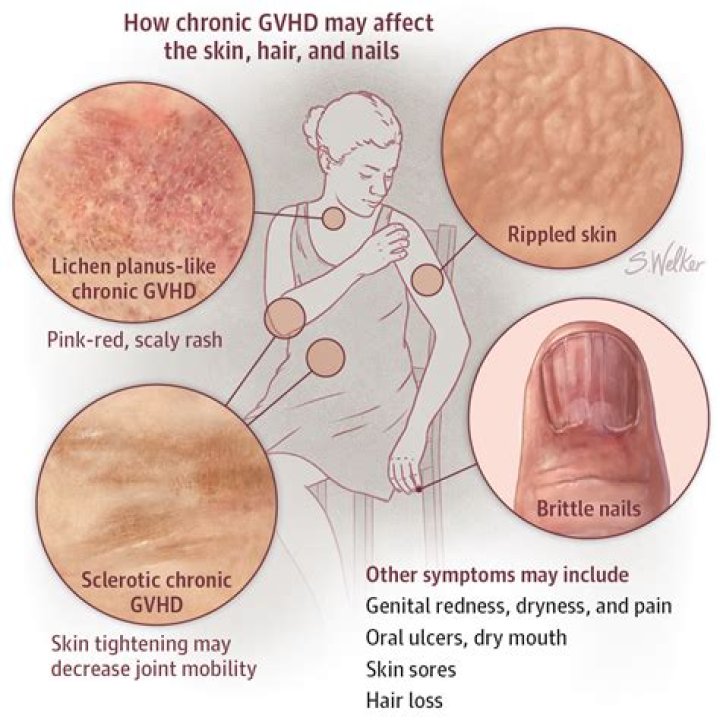 What does GVHD of the skin look like?