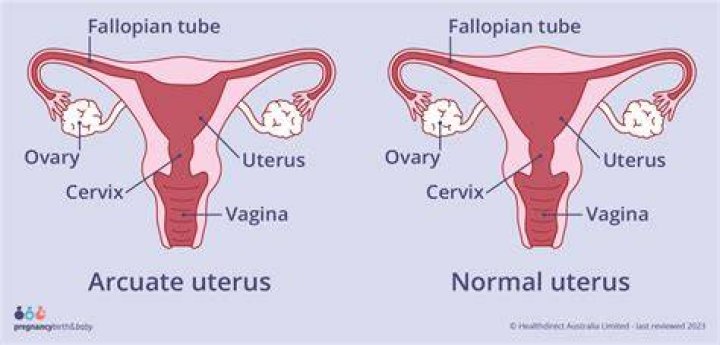What does it mean when your uterus is shaped like a heart?