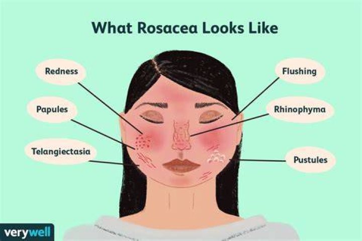 What does rosacea look like in the eyes?