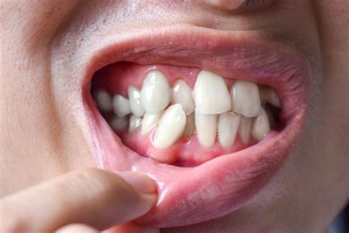 What happens if your top teeth overlap your bottom teeth?