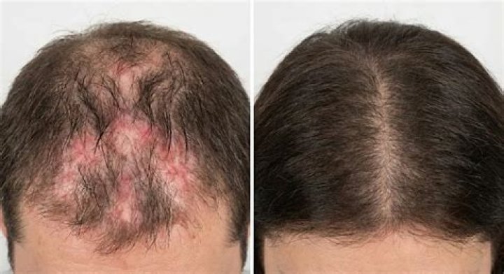 What helps thinning hair from lupus?