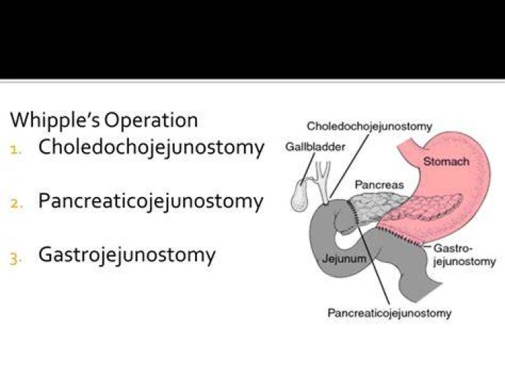 What is a Choledochojejunostomy?