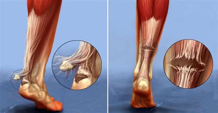 What is Achilles lock?