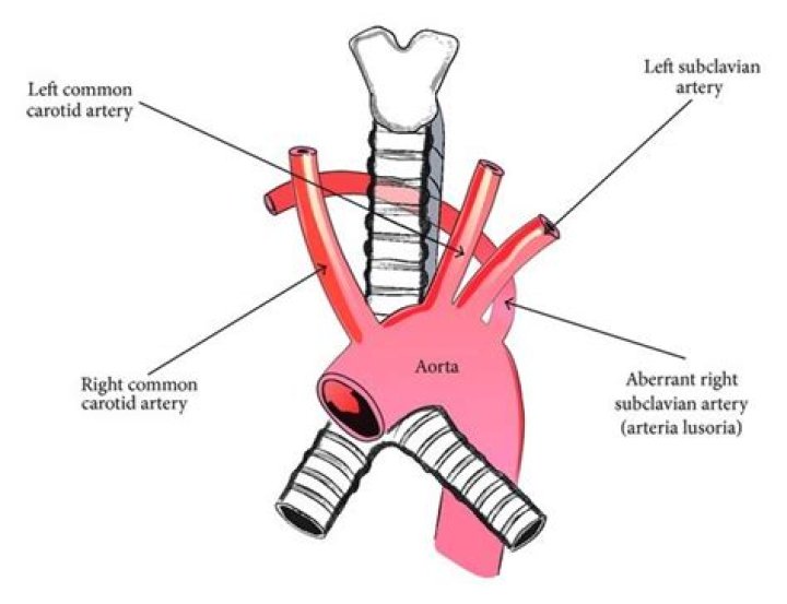 What is an aberrant artery?