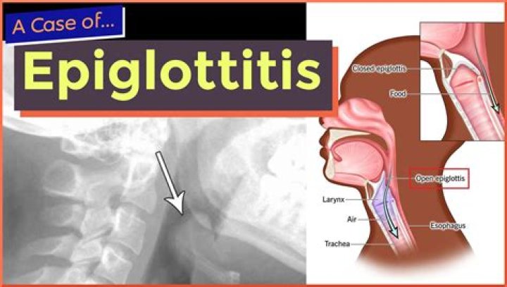 What is an epiglottis picture?