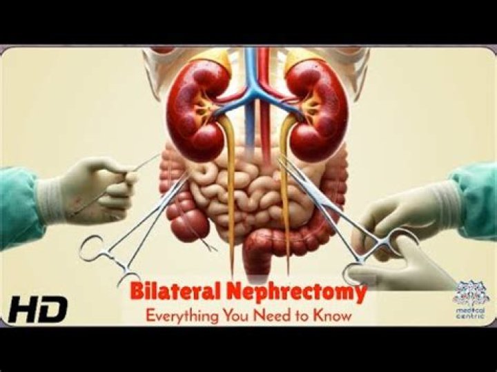 What is bilateral nephrectomy?