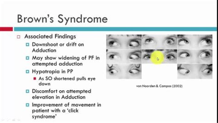 What is Brown syndrome?